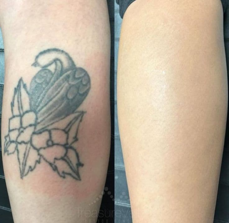 TATTOO REMOVAL example 2
