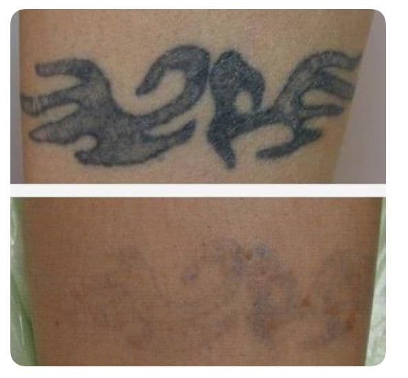 TATTOO REMOVAL example 6